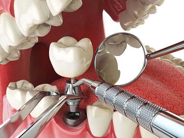 Best Broken or Cracked Tooth Emergency Dentist in Southwest Greensburg, PA